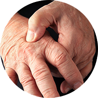 photo of arthritic hands